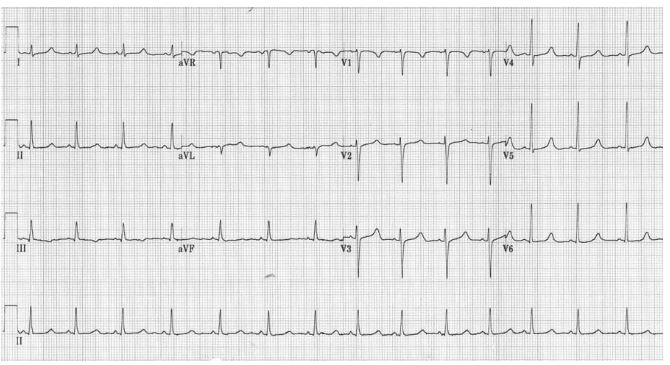 نوار قلب زیر با کدامیک از اختلالات الکترولیتی مطابقت دارد؟ (ACSM R)